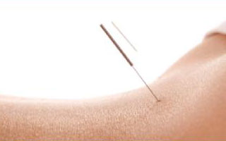 Acupuncture Acupuncture